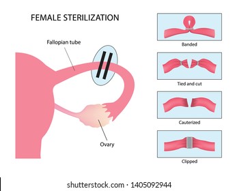 Tubal ligation Images, Stock Photos & Vectors | Shutterstock