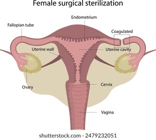 Esterilización quirúrgica femenina. Сcoagulación. Método de anticoncepción femenina. Ligadura de trompas de Falopio.