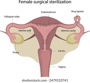 Chirurgische Sterilisation der Frau. Methode der weiblichen Verhütung. Ligatur des Eileiters. Ring ligiert.