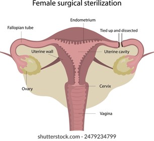 Esterilización quirúrgica femenina. Método de anticoncepción femenina. Ligadura de trompas de Falopio. Atado y disecado trompas de Falopio.
