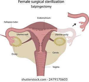 Esterilización quirúrgica femenina. Salpingectomía. Método de anticoncepción femenina.