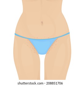 female torso, woman in blue bikini with irritation in the bikini area from shaving