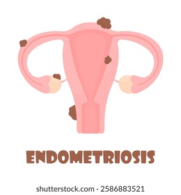 Female uterus affected by endometriosis in cartoon style on a white isolated background. Unhealthy female reproductive system. Women's health concept