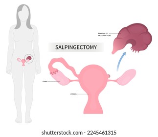 Female uterus biopsy surgical ovary tubal cyst pelvic cancer tumor disease anatomy pain hormone tube birth contraceptive BRCA Salpingo gene mutation Tubo Blocked IVF In Vitro total C Cesarean section