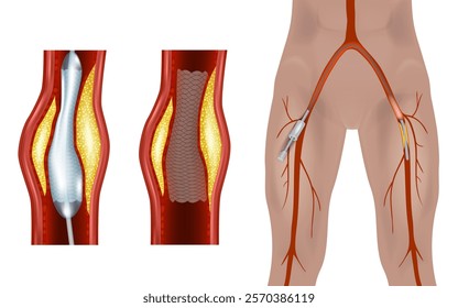 Femoral Endovascular Procedure. Illustration depicting the femoral arteries and popliteal arteries. Angioplasty femoral artery