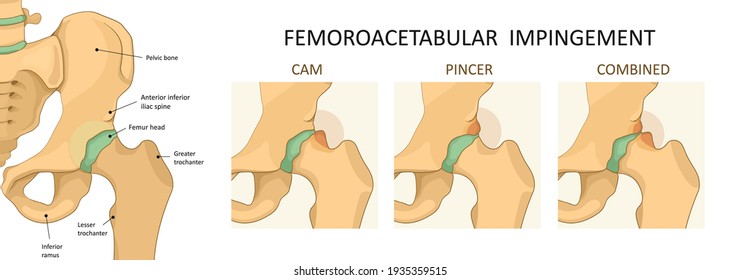 Impacto femoroacetabular (IAL).  Vista frontal de la articulación de cadera con sección de la pelvis. Esqueleto humano, medicina. 