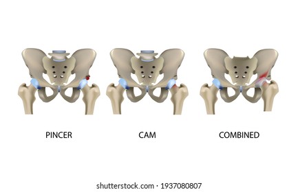 Femoroacetabular impingement, hip joint diseases, realistic medical vector illustration