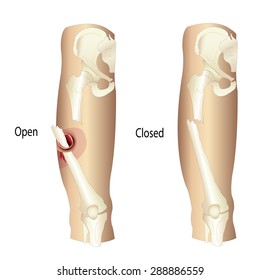 Fracturas de femur, fracturas abiertas y de femur, ilustración de vector cerrado