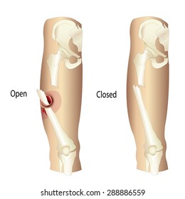 Femur Fractures, Open and Femur Fractures, Closed Vector illustration