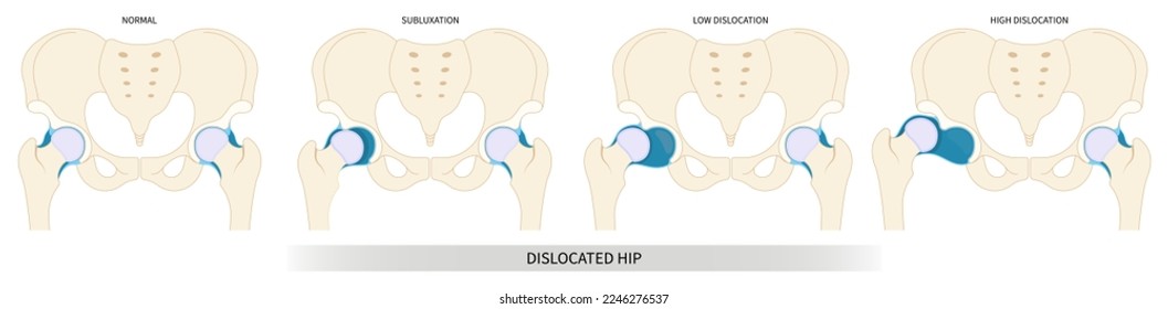 Femur labral tear nerve damage thighbone joint dislocated baby broken pain of leg bone treat unstable pelvis closed loose birth neck chronic sport sciatic prosthesis compression child hurt thigh