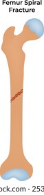Femur Spiral Fracture Vector Illustration