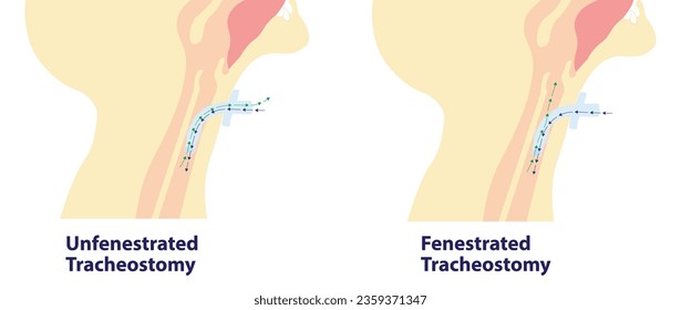 Fenestrated and unfenestrated tracheostomy air flow ilustration. Side view of the differences of air flow with the tracheostomy tube