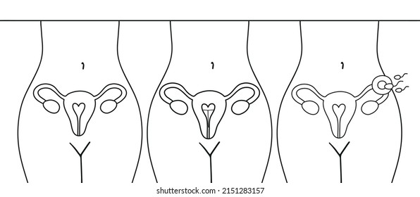 Fertilization icon. Uterus, sperm, insemination. Fertilization in the fallopian tube. The method of IUD contraception is not isolated.