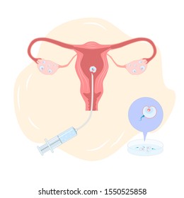 A fertilized egg is transplanted into the uterus. Artificial insemination