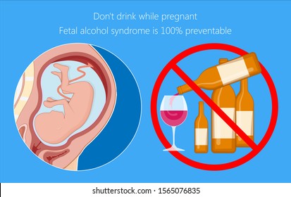 Fetal alcohol spectrum syndrome disorders conditions mother drank during pregnancy cause brain damage and birth defect in children facial