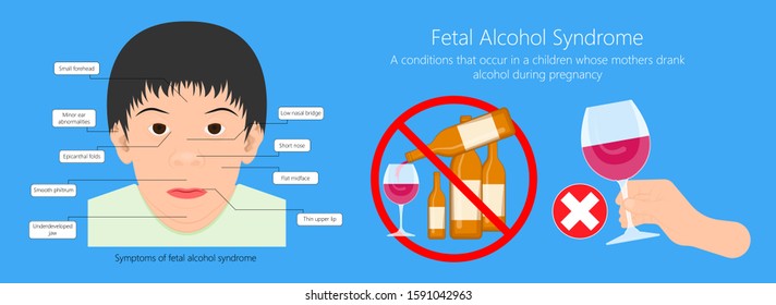 Fetal alcohol spectrum syndrome disorders conditions mother drank during pregnancy cause brain damage and birth defect in children facial