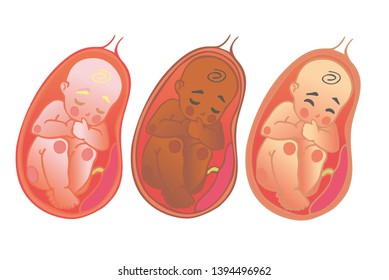 Fetal icon of different races, prenatal human child with placenta silhouette isolated on white background. Image of the baby and placenta inside the uterus.  Design symbol of pregnancy.