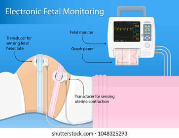 Fetal Monitor FHR Exam Signal Sensor Room Beat Labor CTG Graph Baby Toco Cervix Woman Female Treat Fetus Womb Women Clinic Doctor Mother Labour Midwife Screen Measure Uterus Device Clinical External