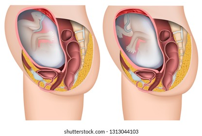 fetus position 3d medical vector illustration