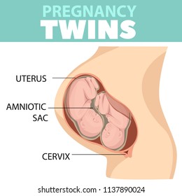 Fetus vector illustration, prenatal human twins child with placenta silhouette isolated on white background.  Detailed vector Infographic. Baby Health