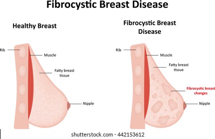 pics of breast changes Crankshaft comic strip