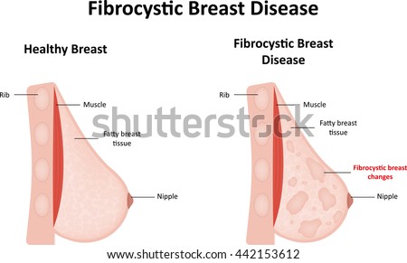fibrocystic breast diseas Fibrocystic breast diseas