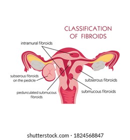 Fibroids, great design for any purposes. Cartoon flat vector illustration. Isolated vector