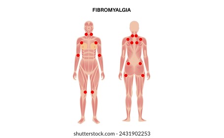 Fibromialgia en el cuerpo femenino. Dolor crónico generalizado en las articulaciones, músculos, fatiga y síntomas cognitivos. Enfermedad musculoesquelética. Puntos rojos en la silueta de la mujer médica ilustración vectorial plana.