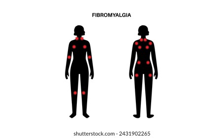 Fibromialgia en el cuerpo femenino. Dolor crónico generalizado en las articulaciones, músculos, fatiga y síntomas cognitivos. Enfermedad musculoesquelética. Puntos rojos en la silueta de la mujer médica ilustración vectorial plana.