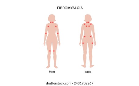 Fibromyalgia in the female body. Chronic widespread pain in joints muscles, fatigue and cognitive symptoms. Musculoskeletal disease. Red points in woman silhouette medical flat vector illustration.