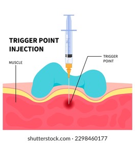 Fibromyalgia Gluteus Medius Pain Anatomy and Myofascial Syndrome Muscle Trauma Trigger Point Office Strain calf hip knee arm or Capitis Fascia Shock Wave fibers shots of Taut Band spasm Sport relieve