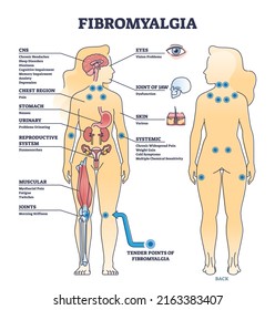 Fibromyalgia as musculoskeletal pain disorder tender points outline diagram. Labeled educational scheme with widespread medical body problems from FMS condition vector illustration. Symptoms list.