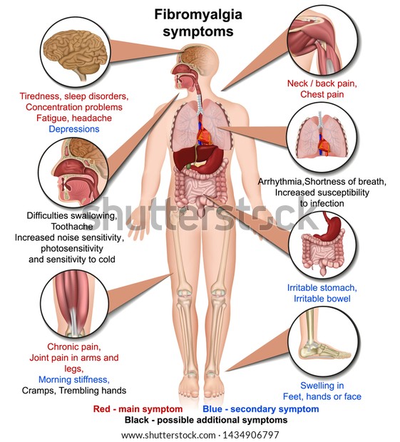fibromyalgia symptoms medical vector
illustration isolated on white background
infographic