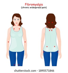 fibromyalgia tender point map. Rheumatology. woman with location of the nine paired tender points of chronic widespread pain. 