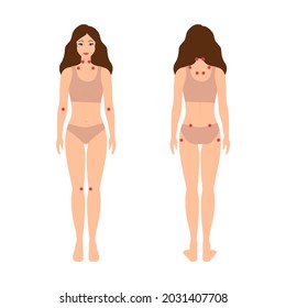 Fibromyalgia Trigger Points, Tender Point Map.