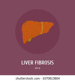 Fibrosis of the liver. Hepatitis. Diseases of internal organs of alcoholics. Vector Flat Illustration