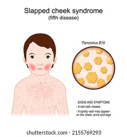 Fifth Disease. Signs And Symptoms. Child Has Slapped Cheek Syndrome. Infectious Disease. Close-up Of Parvovirus B19. Vector Illustration