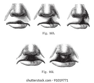 Fig. 163. Degrees of cleft lip simple,  Fig. 164. Cleft lip double, vintage engraved illustration. Usual Medicine Dictionary - Paul Labarthe - 1885.