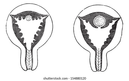 Fig. 961. Arrival of the egg on the uterine mucosa congested, Fig. 962. The egg is almost surrounded by the uterine mucosa hypertrophied. Usual Medicine Dictionary - Paul Labarthe - 1885.  
