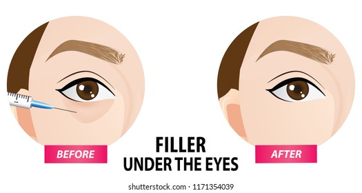Filler injection under the eyes vector illustration 