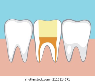Un diente sano que se llena sin nervio. Ilustración de material vectorial plano. Tratamiento de canal, despulpación del molar. Dientes en las encías de un adulto. tratamiento de caries