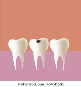 Filling tooth in mouth, Vector illustration.