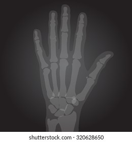 film x-rays of hand for medical learning and study concept. Easily understand radiology of bony structure, scaphoid, lunate, triquetral, pisiform, trapezium, trapezoid, capitate, hamate and phalanges.