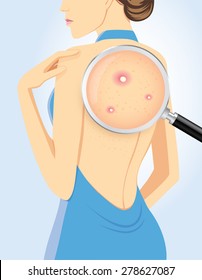 Finding acne on back of beauty women with magnifying glass