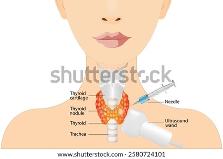 Fine needle aspiration biopsy of the thyroid gland in a patient using an ultrasound machine. Thyroid biopsy