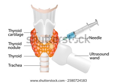 Fine needle aspiration biopsy of the thyroid gland