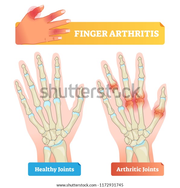 Finger Arthritis Vector Illustration Educational Example Stock Vector