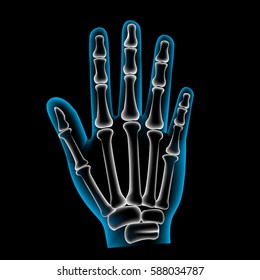 Finger bone, pain, x ray, Broken finger