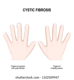 Finger clubbing in cystic fibrosis (genetic disorder). difference between healthy hand and Fingers of a person with cystic fibrosis. Nail clubbing Symptoms (Drumstick fingers or watch-glass nails)