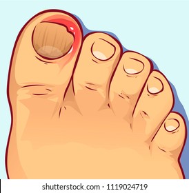 Finger with ingrown nail, vector illustration 